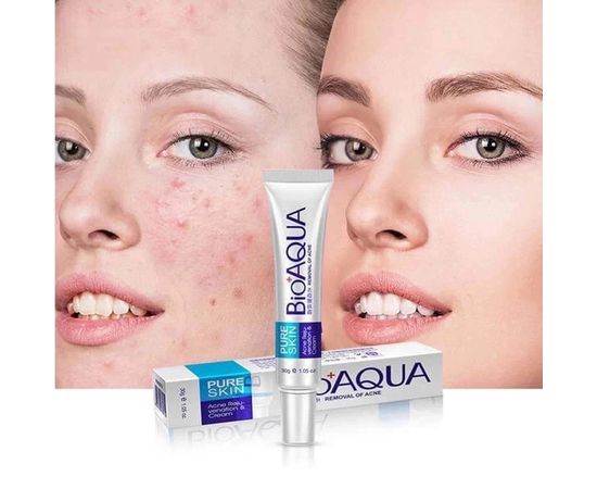 КРЕМ ОТ ПРЫЩЕЙ Pure Skin Removal of Acne Cream, код 50114197